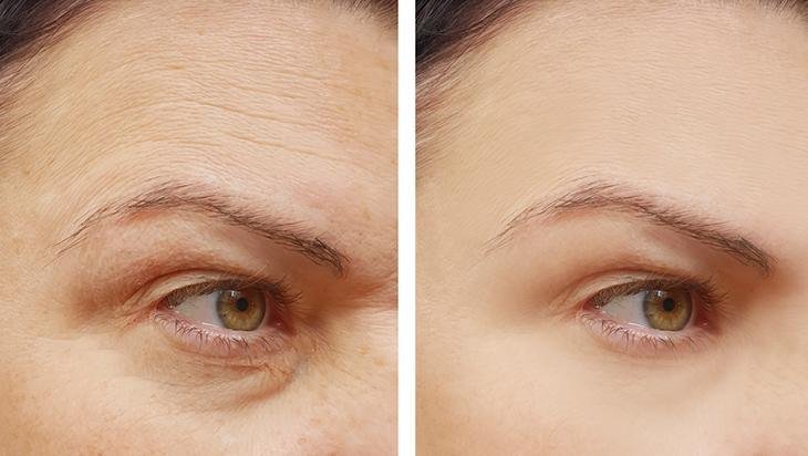Bronz teni uzun süre korumanın doğal yolu Peeling ile pürüzsüzlük garantili