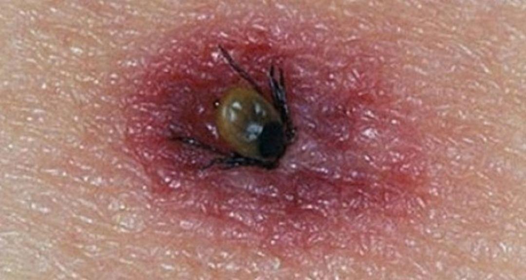 Kene ısırığı vakalarında ciddi artış! 15 gün boyunca kan emerek yaşarlar: 
