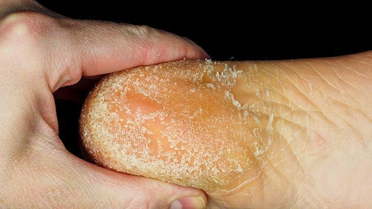 Güzellik uğruna yara eden var Çatlayan topuk böyle iyileşiyor, ovalamaya hayır