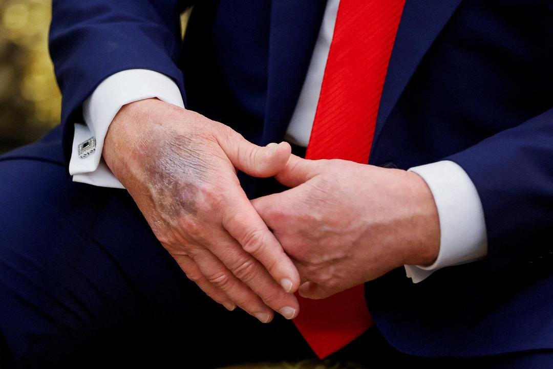 O ziyaret sırasında dikkat çekti! ABD Başkanı Trump ın elindeki morluk gündem oldu: Beyaz Saray dan açıklama geldi 3