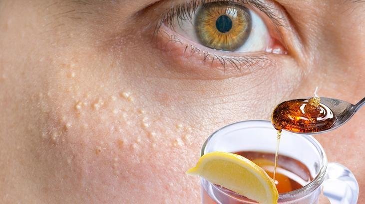 Yüzdeki yağ bezelerine bal-limon