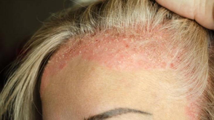 Egzama ve kuruluğa doğal retinol Cildi canlandıran ürünün tek damlası yetiyor Egzama ve kuruluğa doğal retinol Cildi canlandıran ürünün tek damlası yetiyor