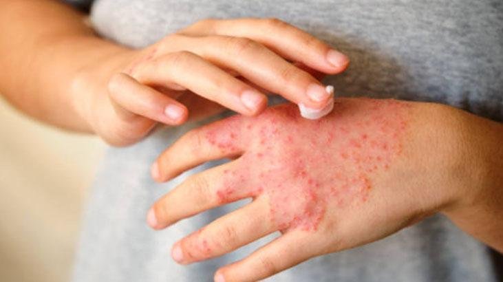 Egzama ve kuruluğa doğal retinol Cildi canlandıran ürünün tek damlası yetiyor Egzama ve kuruluğa doğal retinol Cildi canlandıran ürünün tek damlası yetiyor