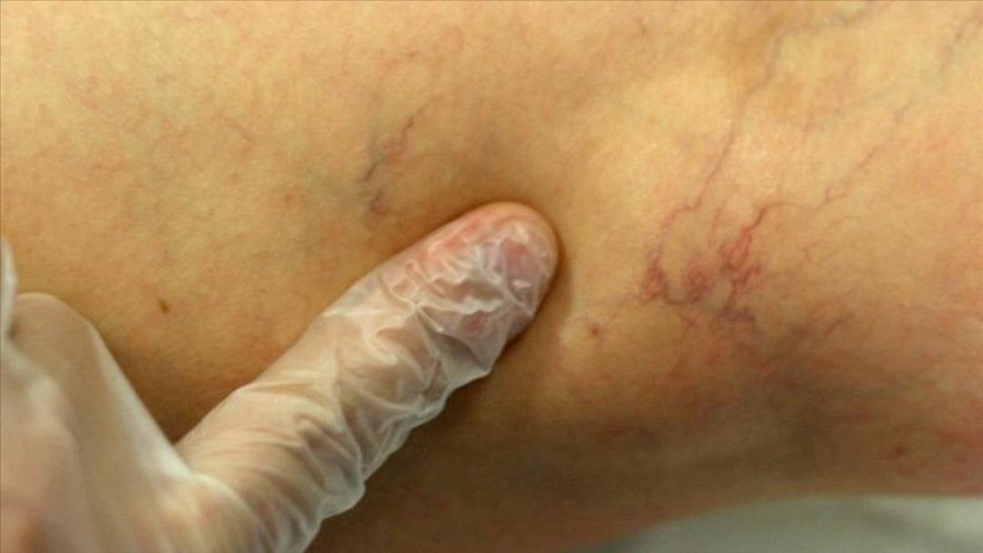 Bacak ağrısı ve kramplar hangi hastalığın habercisi? 2